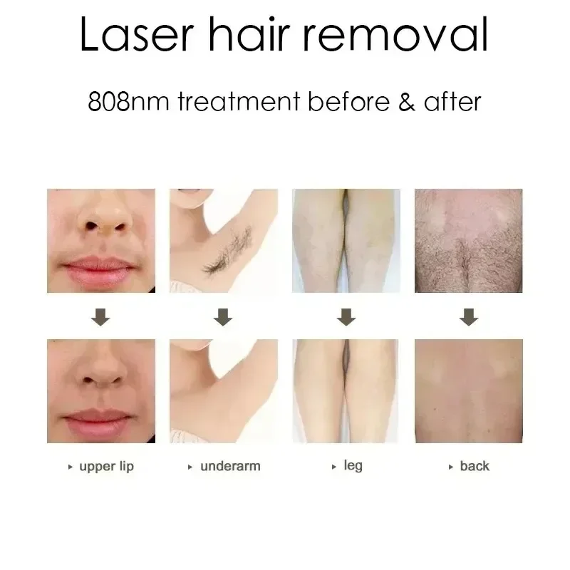 Laser pikosekundowy 1064 532 755 940 Q przełącznik Nd Yag Laser obieraczka węglowa Tatuaż Peeling węglowy usuwanie punktowe wskaźnik laserowy