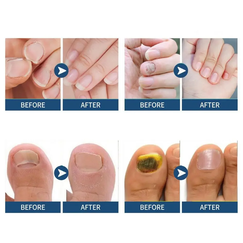 32개입 곰팡이 손톱 패치, 발톱 곰팡이 치료용 강력 – 손상되고 변색된 손톱을 위한 밤새 손톱 관리 및 복구
