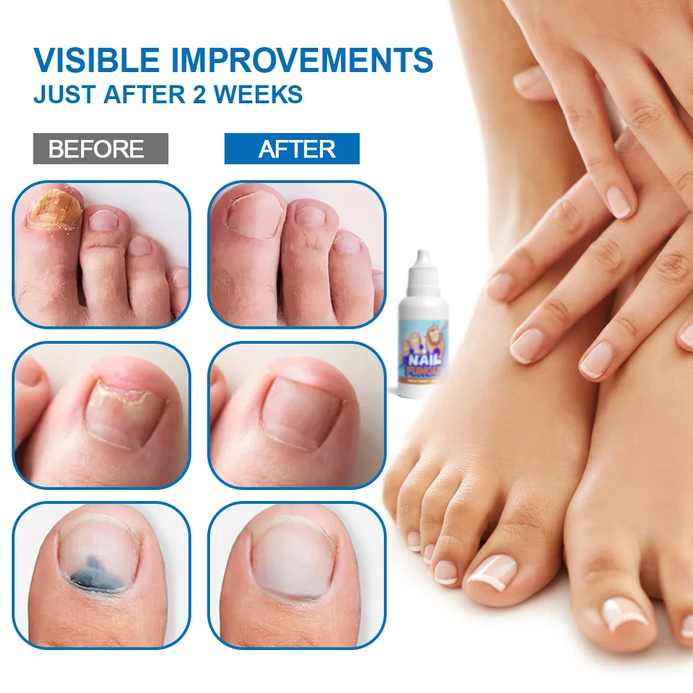Crema de renovación de Uñas, bálsamo Natural Extra fuerte para Uñas, tratamiento de hongos para Uñas descoloridas