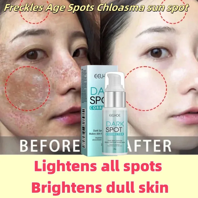 

Nicotinamide Whitening Freckle Cream Removes Melasma Dark Spots Lighten Black Skin Brighten Lotion Anti-Aging Beauty Skin Care