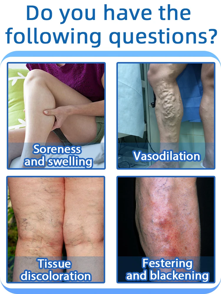 Hot-selling blue laser can effectively repair leg veins