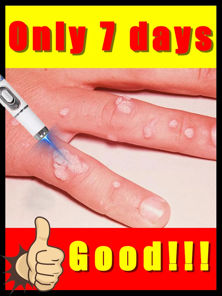 

blue light pen solve warts,home use,hotsale wart care tools,free shipping,easy to use