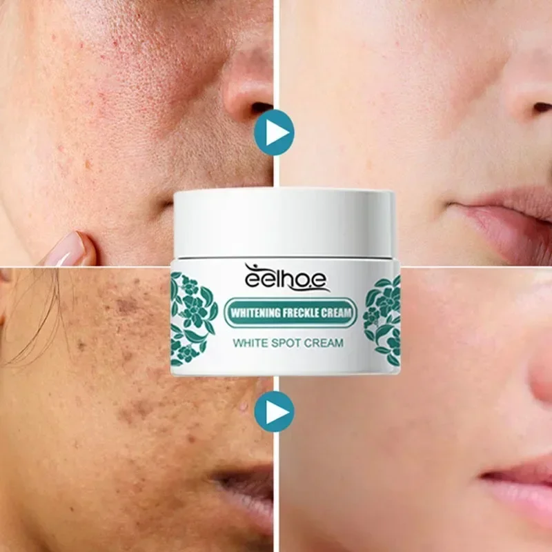 Creme Clareador De Melasma, Niacinamida, Clareamento De Melanina, Clarear A Pele Escura, Soro De Cloasma, Desvanecer-se Belas Linhas Rosto