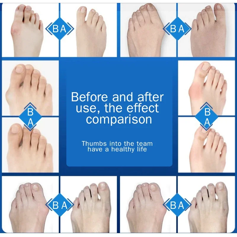 1PCS/1Pair Hallux Valgus Corrector Bunions For Toes Corrector Foot Finger Separator Foot Care