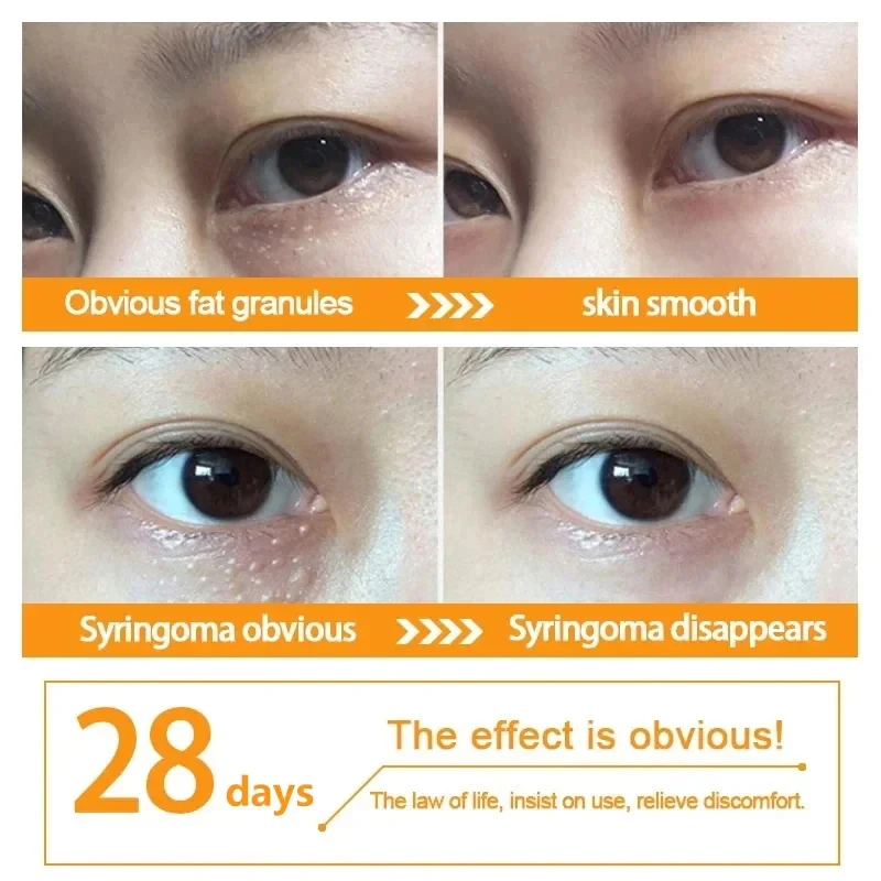 Fat Granules Remover Eye Cream Anti Inflammatory Anti-Puffiness irm Cream Reduce Dark Circles Fade Fine Lines Repair Barrier