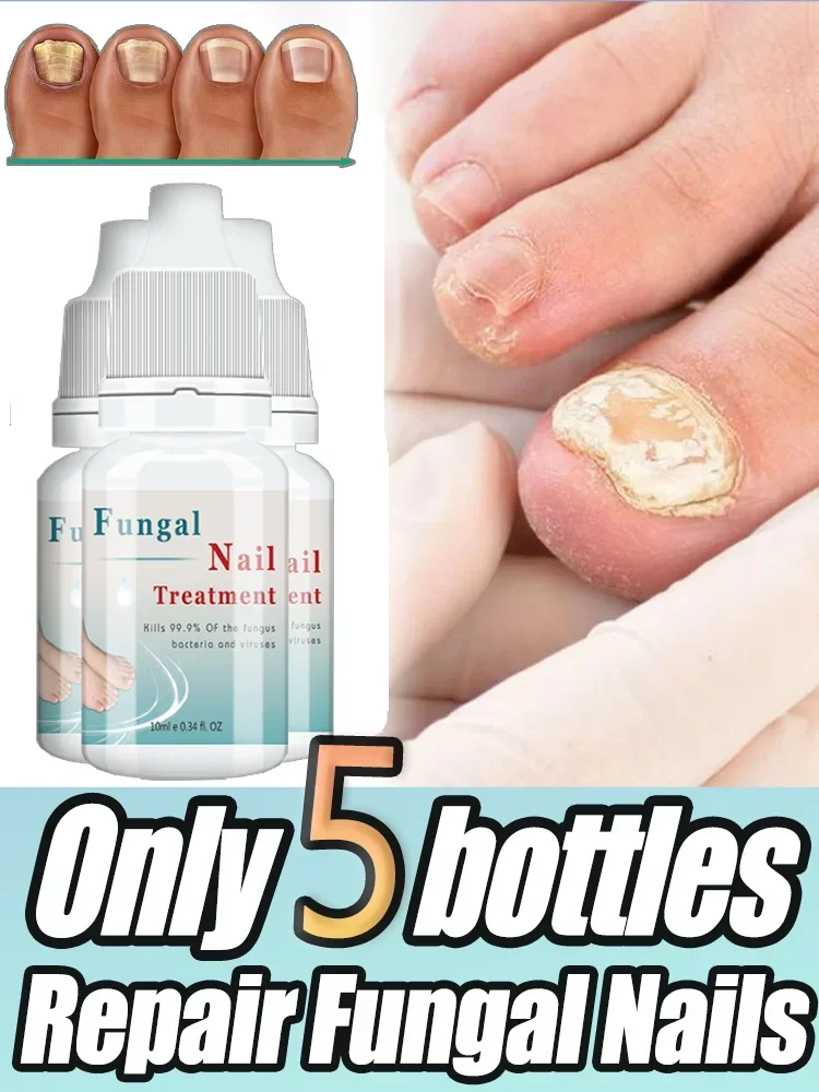 

Nail Fungus Treatment oil Foot Repair Liquid Toe Nails Fungal Removal Gel Anti Infection Paronychia Onychomycosis Serum 10ml