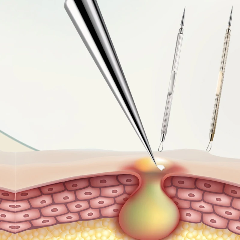 1 szt. zaskórnika zaskórnik trądzik pryszcz środek do usuwania skaz igły ze stali nierdzewnej usuń narzędzia pielęgnacja skóry twarzy środek do oczyszczania porów