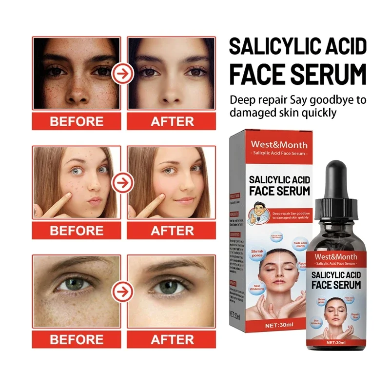 Niacinamide Facial Serum Salicylic Acid Moisturizing Fade Spots And Acne Marks Shrink Pores Skin Care Products 2024