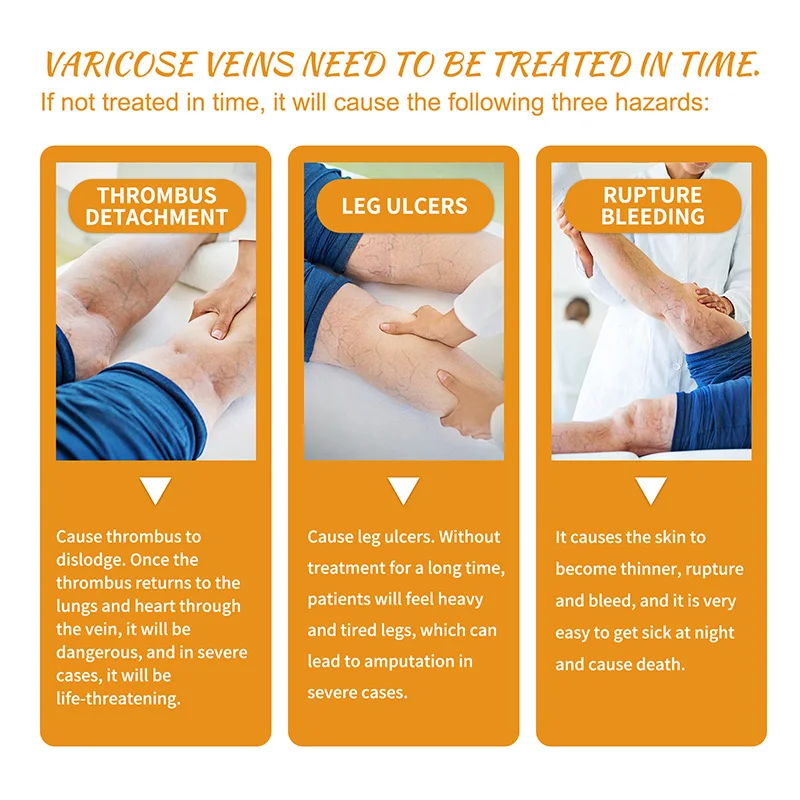 Varicose Veins Cream for Legs Relief Body Care Products 60g