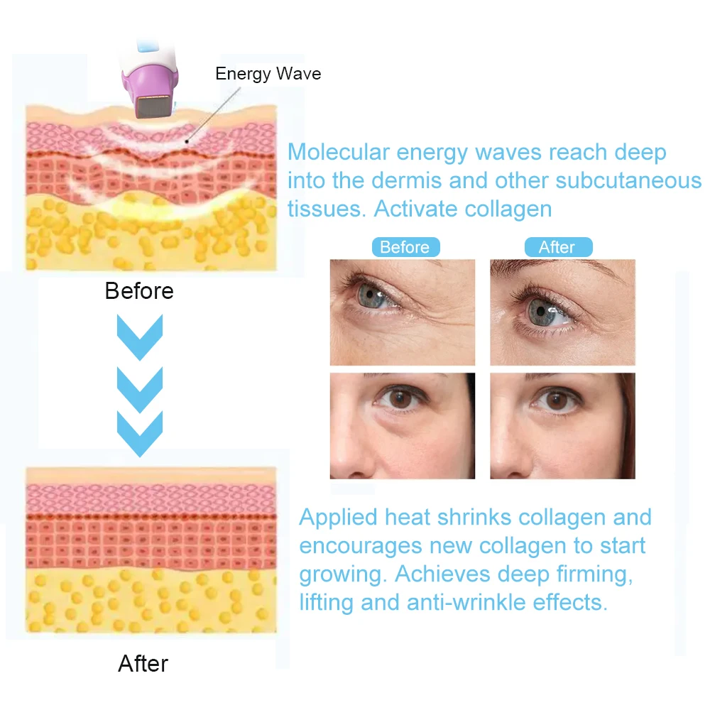 YUET WIN-máquina fraccional para el cuidado de la piel, rejuvenecimiento de la piel, eliminador de arrugas, antienvejecimiento, reafirmante, dispositivos de Estiramiento facial