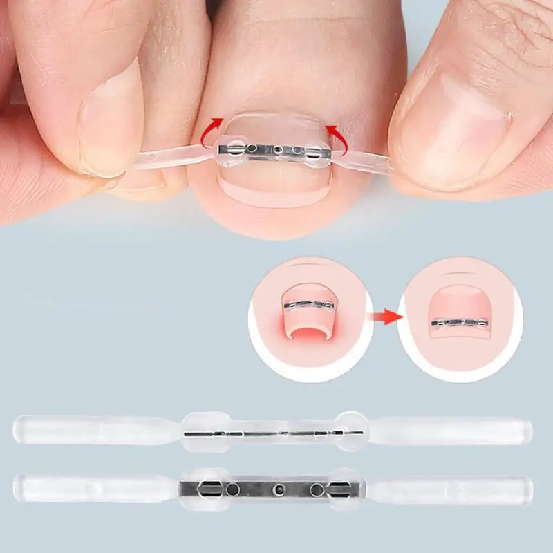 Corrector de uñas encarnadas, herramientas para pedicura, recuperación integrada, tratamiento de uñas de los pies, soporte profesional para alisar uñas encarnadas
