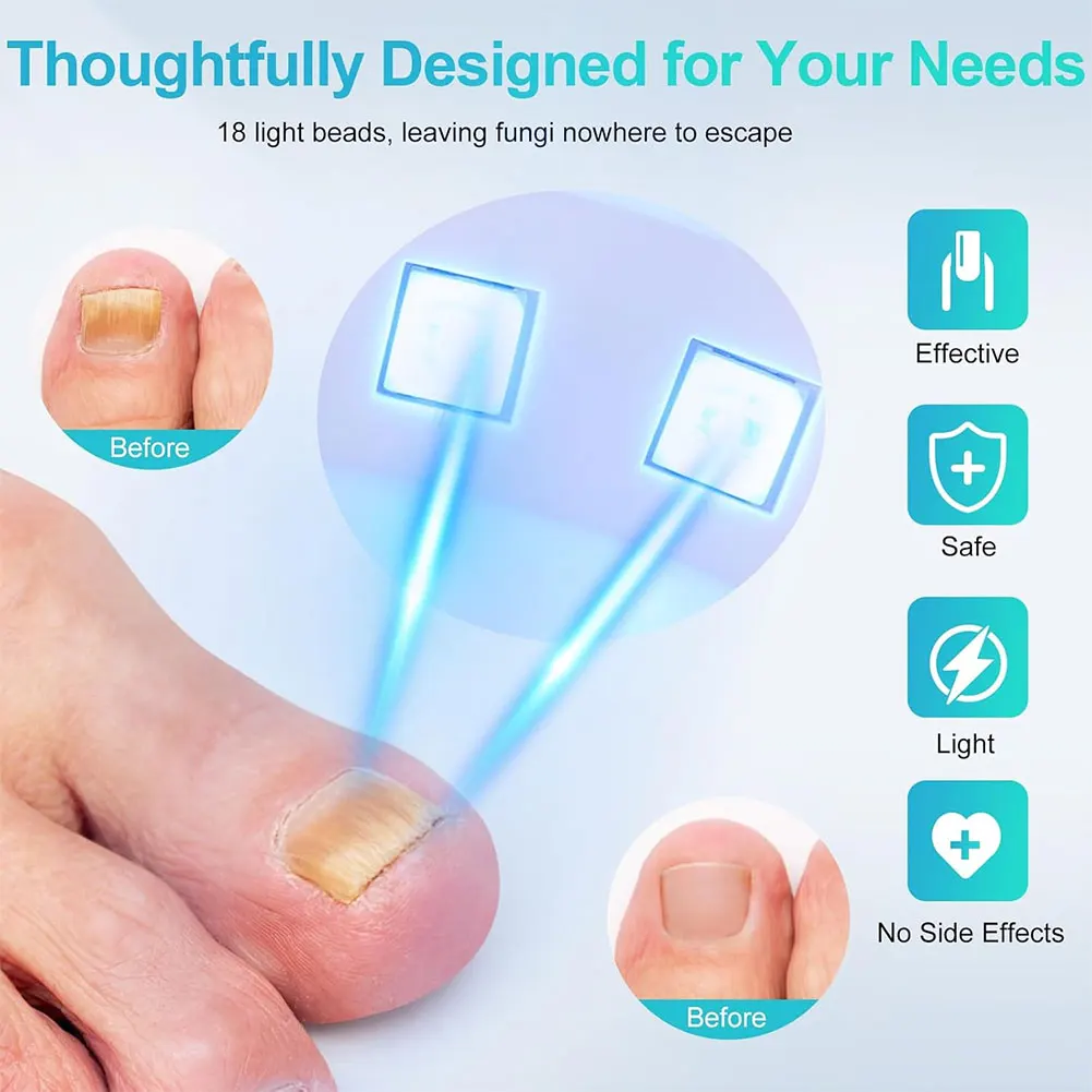 جهاز ضوء الأظافر للاستخدام المنزلي، حل إصلاح الأظافر 470 نانومتر، جهاز علاج الأظافر بالضوء الأزرق لأظافر القدم المتغيرة الملونة والسميكة