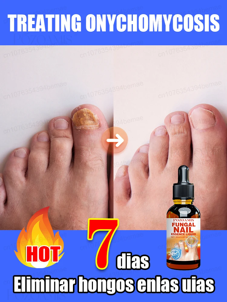 

Nail fungus treatment essential oil, repair onychomycosis in 7 days