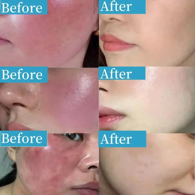 Instant Repair Redness Serum 7X Relief Red Blood Itching Improve Rosacea Shrink Pore Oil Control Moisturizing Sooth Facial Care