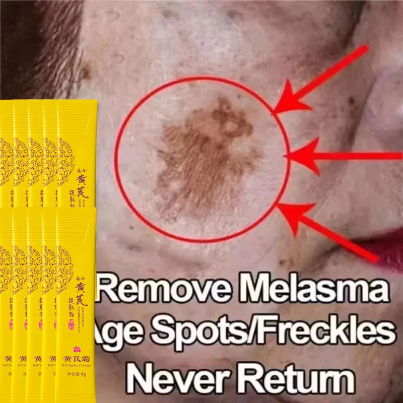 Powerful Spot-removing Whiten Cream Brighten Skin Fast Eliminates Melanin Pigmentation Melasma Dark Spots Moisturize Beauty Gel