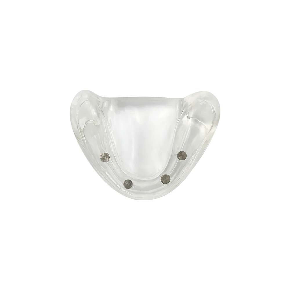 Removable Lower Jaw Implant Practice Model Dental Overdenture Teeth Model for Removable Implant Model For Dentist Communication