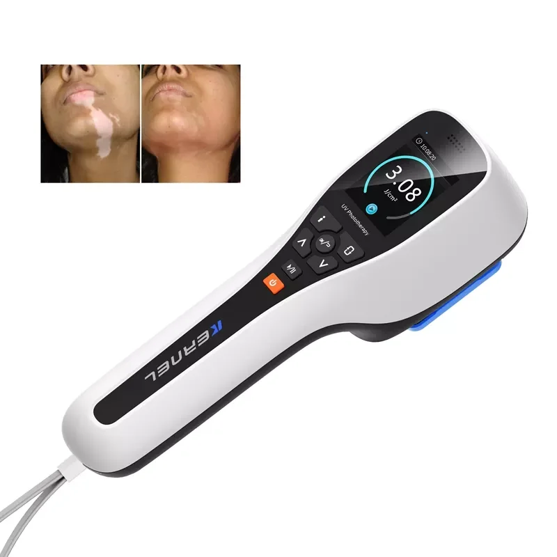 Kernel KN 5000G Home Use 308nm Excimer Laser Machine for Leukoderma Scalp Psoriasis Treatment