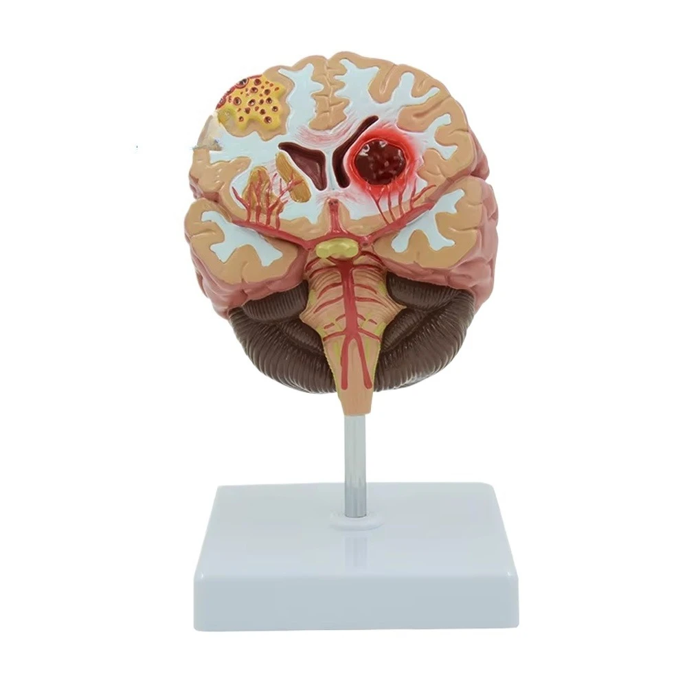 

Realistic Medical-grade Eco-friendly PVC Stroke Brain Anatomy Model for Medical School and Stroke Mechanism Demonstration