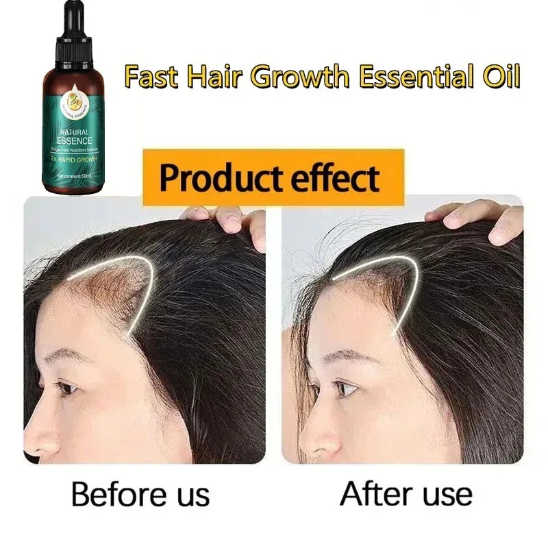 Óleo Essencial Soro De Crescimento Rápido Do Cabelo, Cuidados Com O Cabelo Gengibre, Produtos De Recrescimento, Perda De Cabelo Série, Natural, Novo