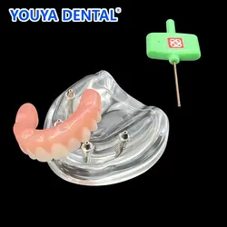 Z implantem Overdenture 4. Wyjmowane śruby. Model górnych zębów. Doskonały model demonstracyjny Typodont. Model do nauki implantów. Model dydaktyczny