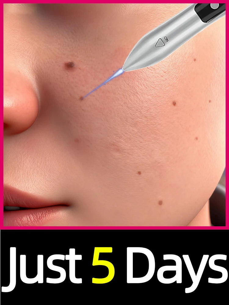 

2025 New Upgrade Laser Solve Wart Tool Big Promotion