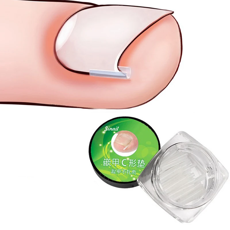 Almohadilla de silicona para uñas encarnadas, 10 piezas, relleno de uñas encarnadas, Corrector de uñas encarnadas, alivio del dolor, herramienta de corrección de paroniquia