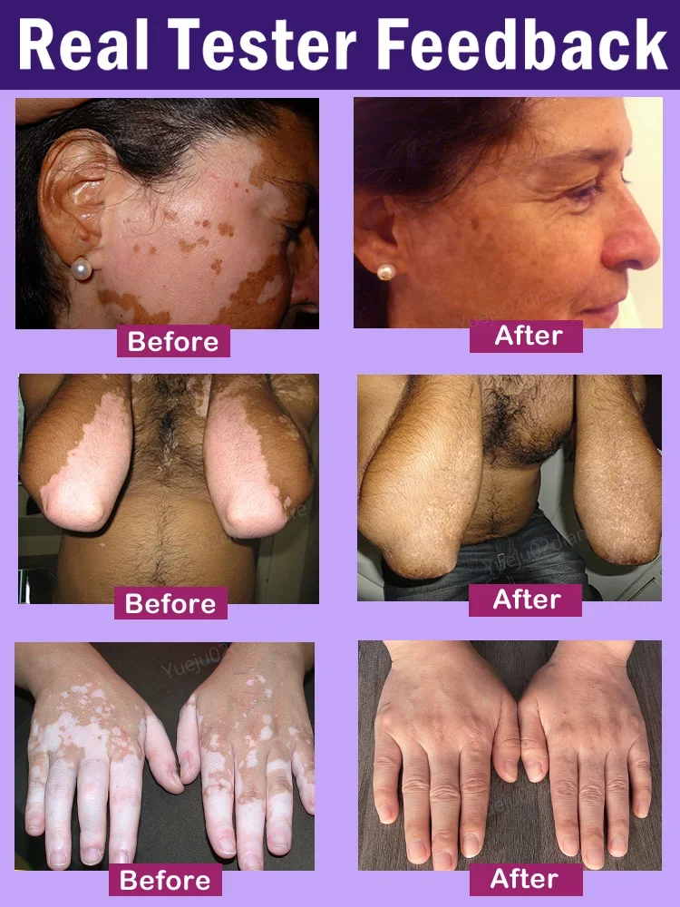 Vitiligo Ointment Effectively Improvement White Spot Skin Eliminate