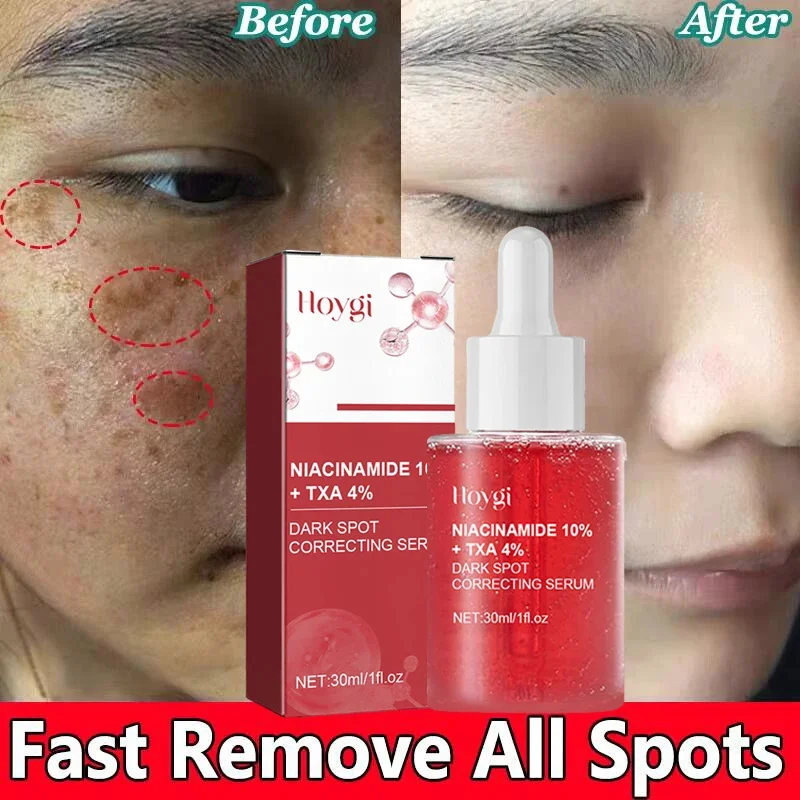 

Powerful Whitening Freckles Serum Dark Spot Remover Nicotinamide Lightening Melanin Blemish Moisturizer Brighten Face Skin Care