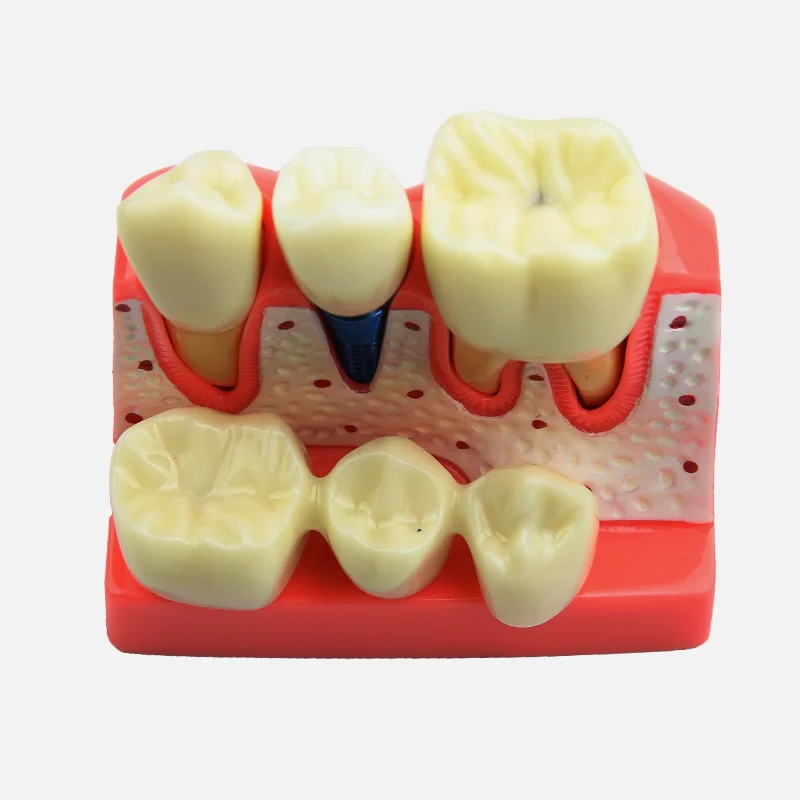 Dental Model Dental Implant Model Denture Bridge Crown Porcelain Restoration Model Dentist Teaching Demonstration Models