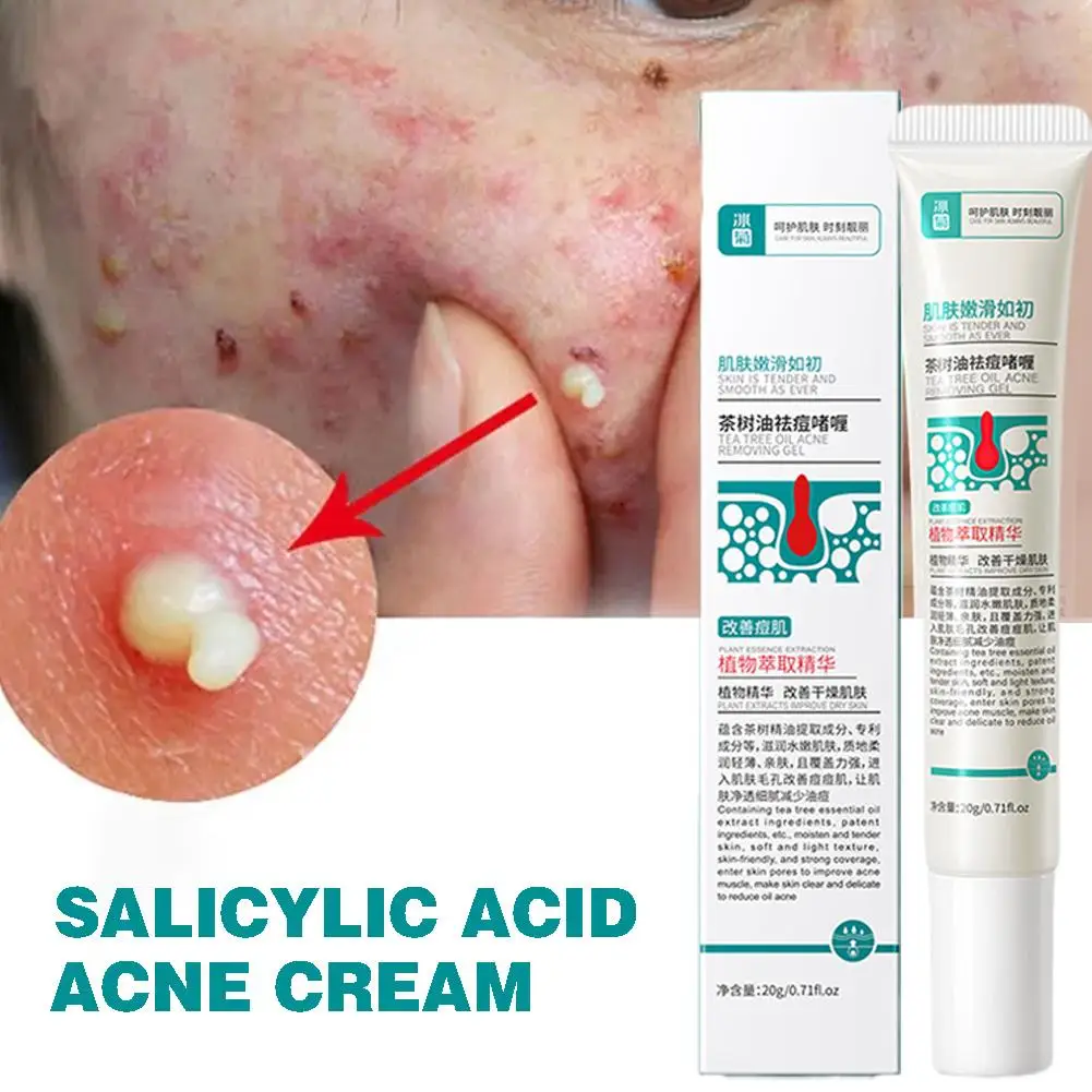 Creme anti-inflamatório do óleo da árvore do chá, reduzir espinhas da acne, controle das nádegas, equilíbrio delicado, umidade da pele, anti-inflamatório, 20g, S V5U5