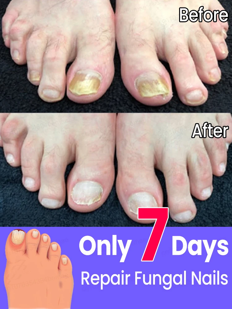 

Say goodbye to the troubles of thick, yellow, and brittle nails