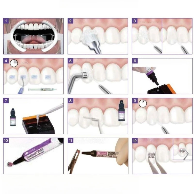 Dental Light Curing Material 3m Orthodontic Adhesive Treatment Agent Oral Consumables 6mL Brackets Orthodontic Adhesive Material