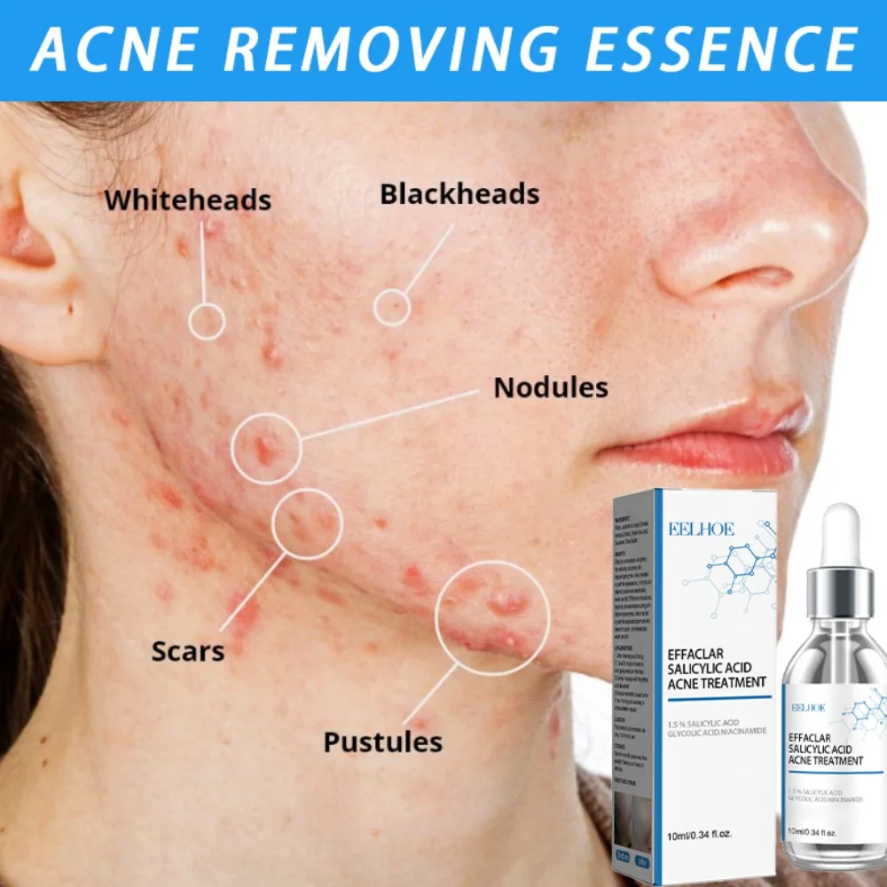 

Facial acne removal serum lasts for long-term moisturizing and shrinking old holes moisturize the skin, making your skin smooth