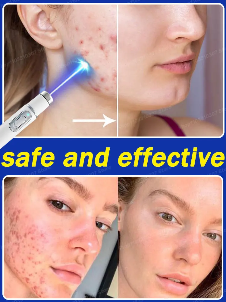 

Anti Acne Scars Cream Blu-ray Pen