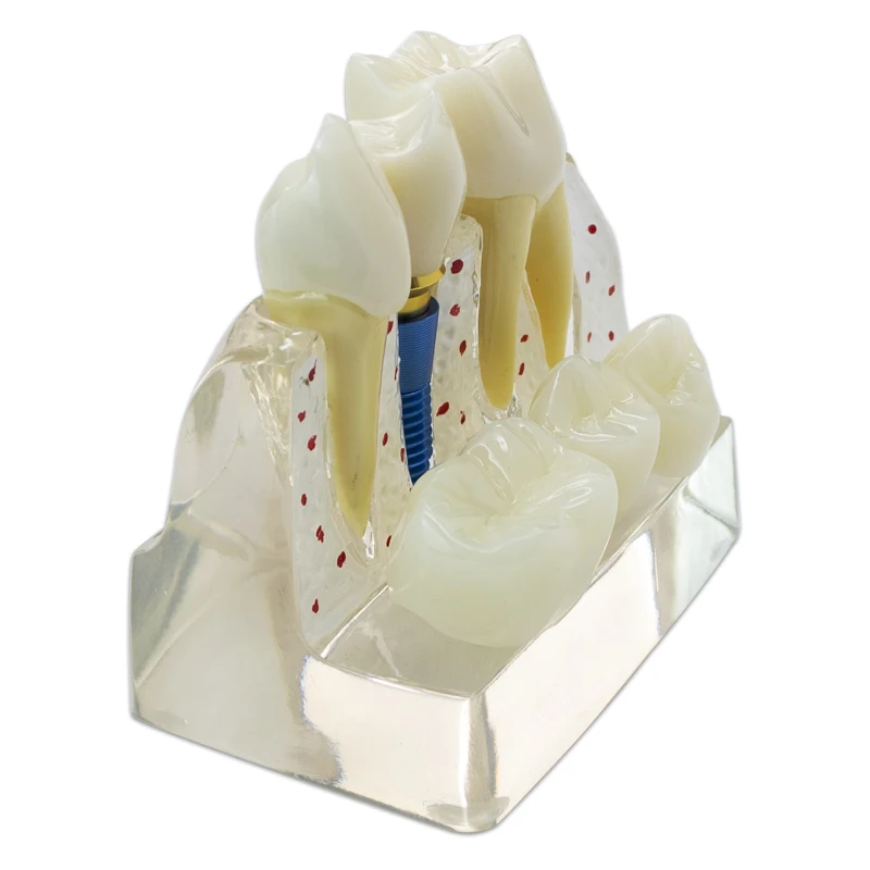 Zahnimplantatmodell, 6/8-fache vergrößerte Karies, kontrastierendes Zahnimplantatmodell, Krone, Zahnimplantatmodelle für Arztpatient-Kommunikation – Detail 6