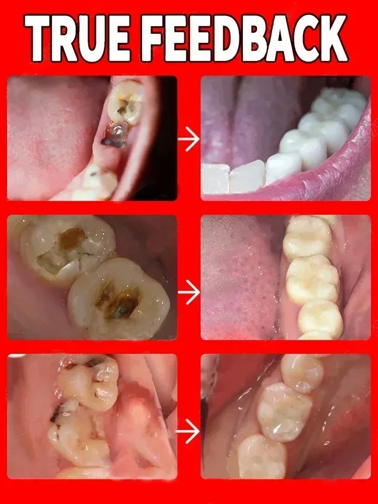 Cuidado Dental avanzado: blanqueamiento Dental anti-cavidad, respiración fresca, eliminación de placa, alivio del dolor de dientes, reparación de la Periodontitis