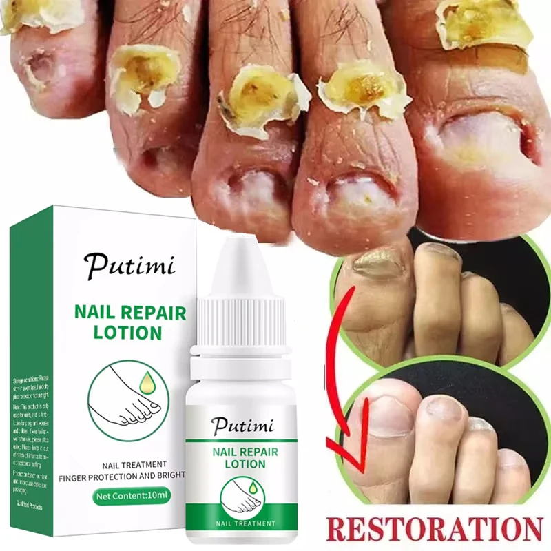 

7 DAYS Nail Fungus Treatments Liquid Serum Anti-Infection Onychomycosis Paronychia Hand Care Nails Foot Fungal Removal Gel 10ml