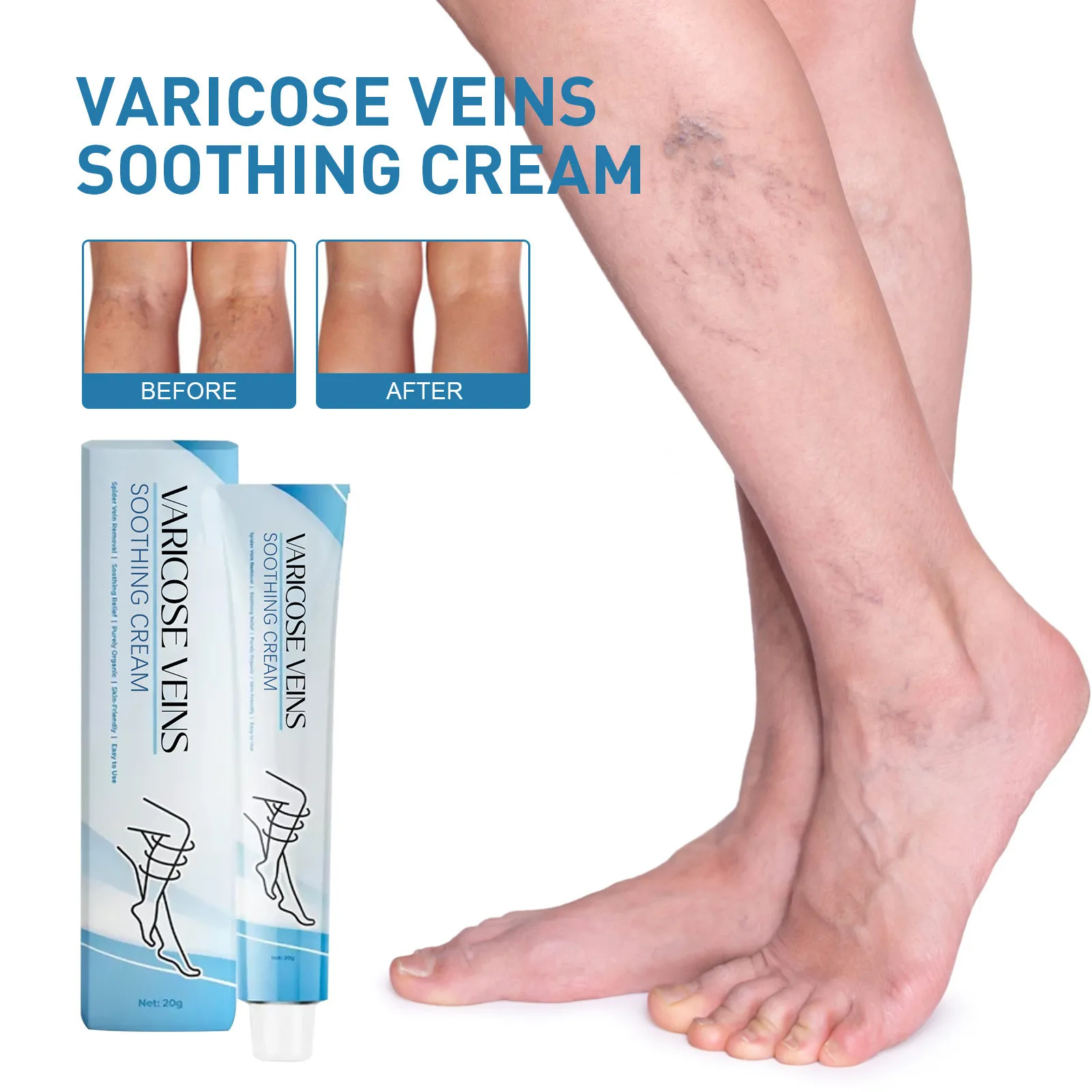 Venoheal Varicose Vein Ease Paste Varicose Veins Paste Varicose And Spider Veins Ease For Legs Improve Blood Circulatio party