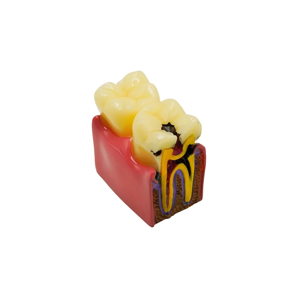 1set Dental Caries Comparsion Tooth Models 6 Times Study Models for Dentist Studying Teaching Anatomy Practice Teeth Model
