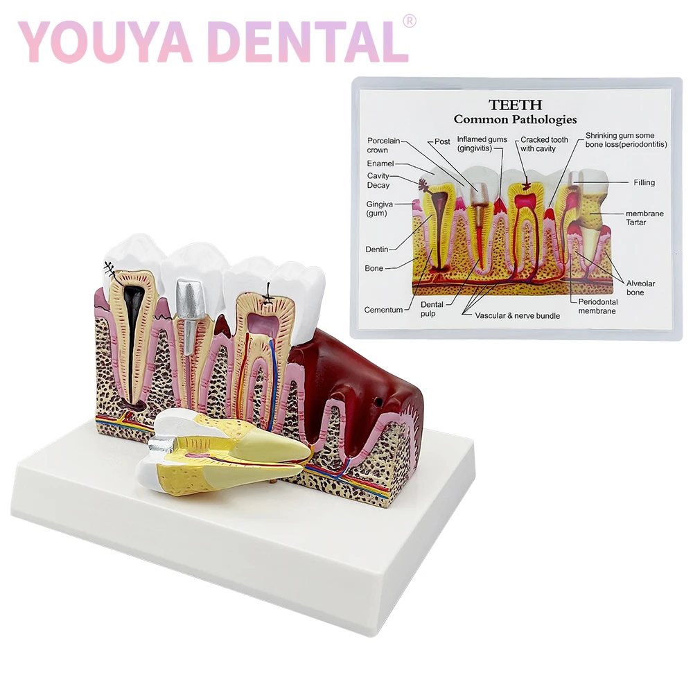 1Pcs Dental Caries Anatomy Model Comprehensive Pathology Tooth Nerve Tooth Model Oral Education Training Tooth Model