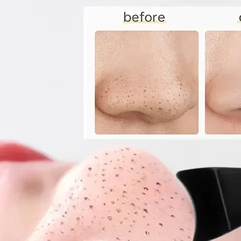 Herramienta Popper 2 en 1 para espinillas, eliminador de espinillas, tratamiento de eliminación de agujas de acné, Extractor de imperfecciones de cara y nariz, 1 ud.