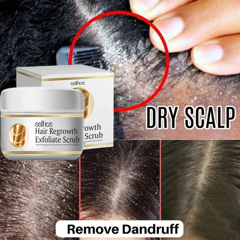 Fast Anti Dandruff Hair Treatment Scrub Itching Repair Scalp Cleaning Exfoliating Products Oil Control Antipruritic Hair Care