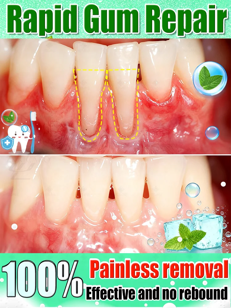 

Eᴀsɪʟʏ ʀᴇɢᴇɴᴇʀᴀᴛᴇ ɢᴜᴍs ᴀɴᴅ ᴄᴏᴠᴇʀ ᴛᴇᴇᴛʜ ɪɴ 7 ᴅᴀʏs