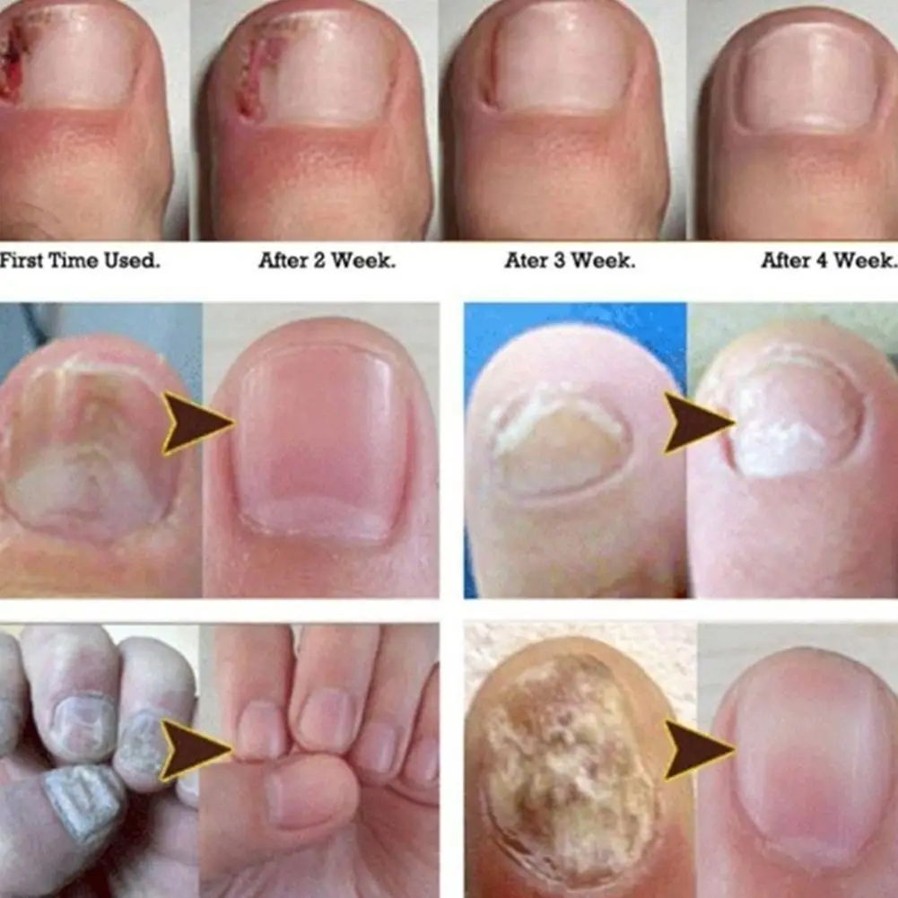 Fungus Removal Liquid Fungal Nail Treatment Foot Care Toe Nails Repair Care Essence Natural Plant Foot Nail Anti Infection Oil
