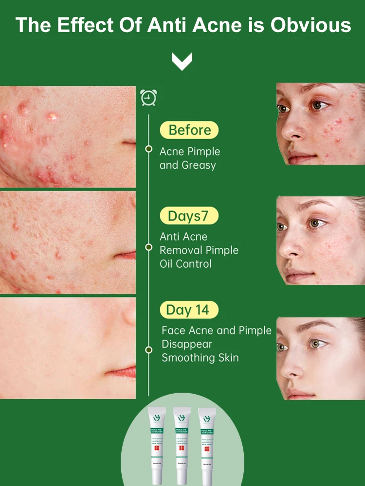 Vervagen Gezicht Acne