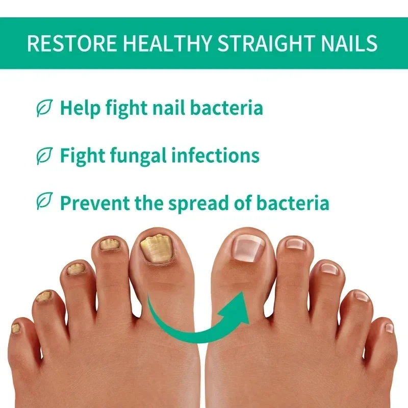 Nail Fungus Tratamento Soro, Remoção De Óleo De Essência, Pés Pregos, Anti Infecção, Toe Fungal Repair, Cuidados Com O Corpo, Creme De Essência