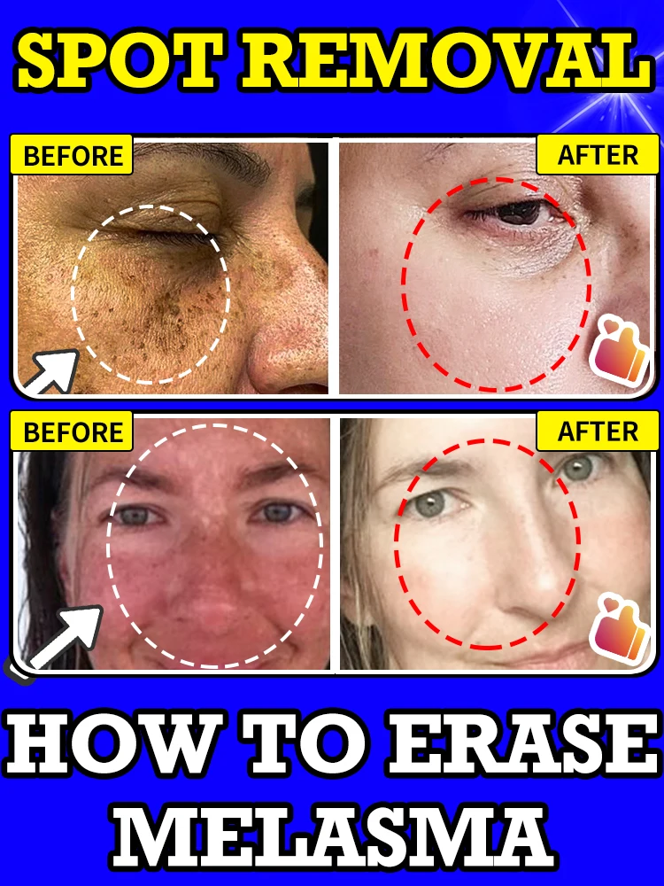 

Multi-Action Spot Correcting Serum Ease Melasma,Dark spot, age spot