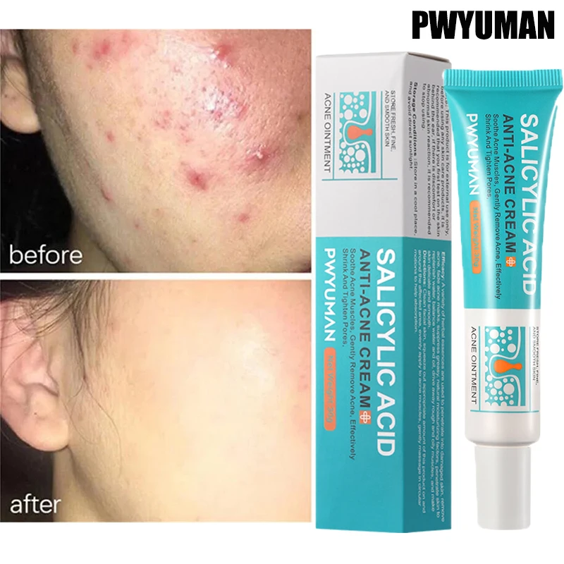 Ácido Salicílico Acne Tratamento Creme Facial, Reparação, Espinhas, Manchas, Limpeza Profunda, Poros, Anti-acne, Cicatriz, Controle de Óleo Hidratante, Cuidados com a pele