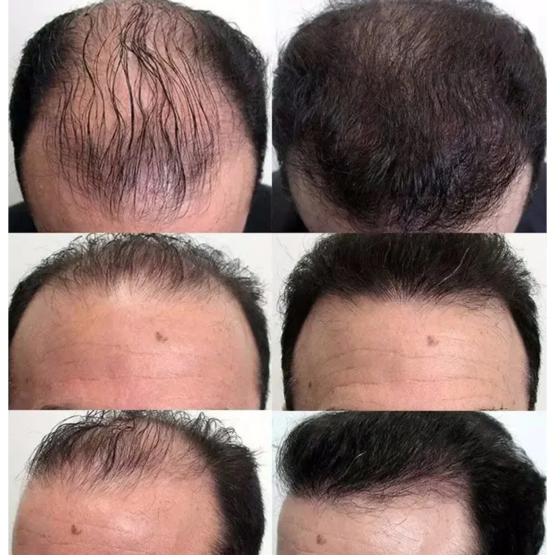 Fast Hair Growth Serum Hair Regrowth Essential Oil Anti Hair Loss Repair Damaged Scalp Women Men Anti Baldness Hairs Growth Care