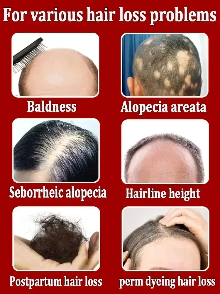 Óleo unisex do crescimento do cabelo para a calvície, tratamento da perda do cabelo, rápido, eficaz, reparo, hereditário, pós-parto